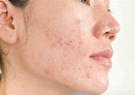 acne comedogenico.